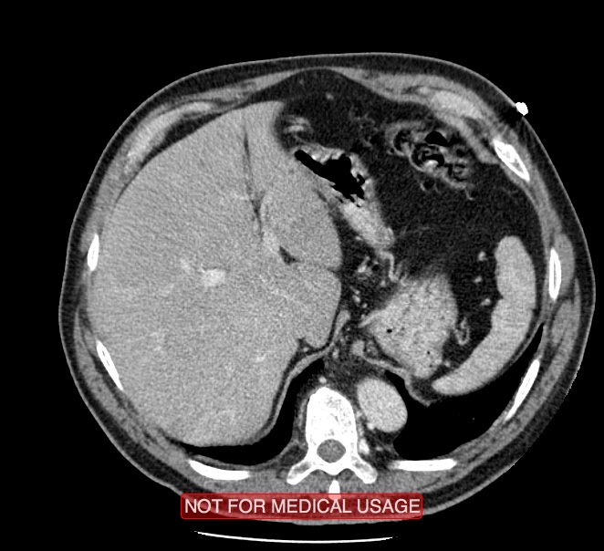 Acute aortic dissection - Stanford type A (Radiopaedia 40661-43285 Axial C+ portal venous phase 63).jpg