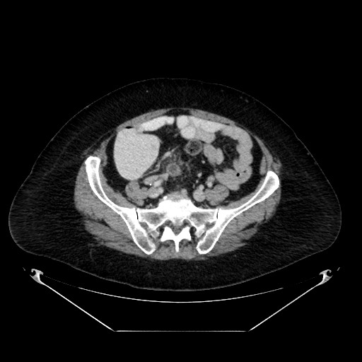 Acute appendicitis, heterotaxy syndrome (Radiopaedia 66884-76202 Axial C+ portal venous phase 93).jpg
