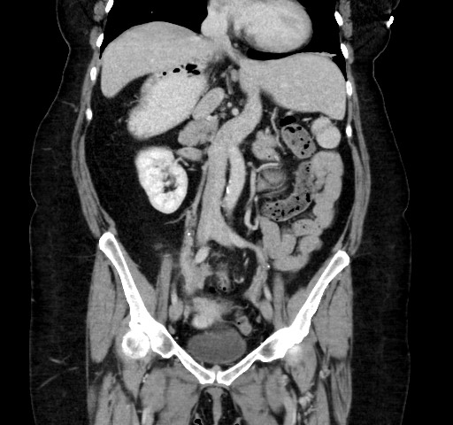 Acute appendicitis, heterotaxy syndrome (Radiopaedia 66884-76202 Coronal C+ portal venous phase 61).jpg