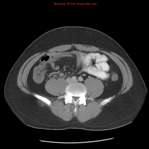 Acute appendicitis (Radiopaedia 10498-10973 Axial C+ portal venous phase 13).jpg