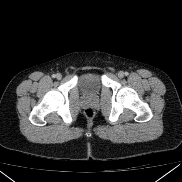 Acute appendicitis (Radiopaedia 38255-40270 Axial C+ portal venous phase 111).jpg