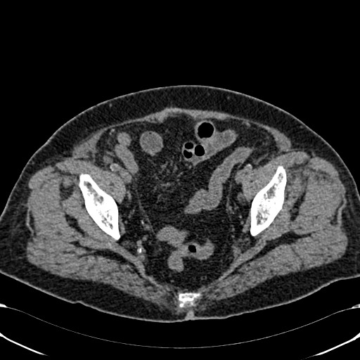 File:Acute appendicitis (Radiopaedia 58627-65818 Axial non-contrast 76).jpg