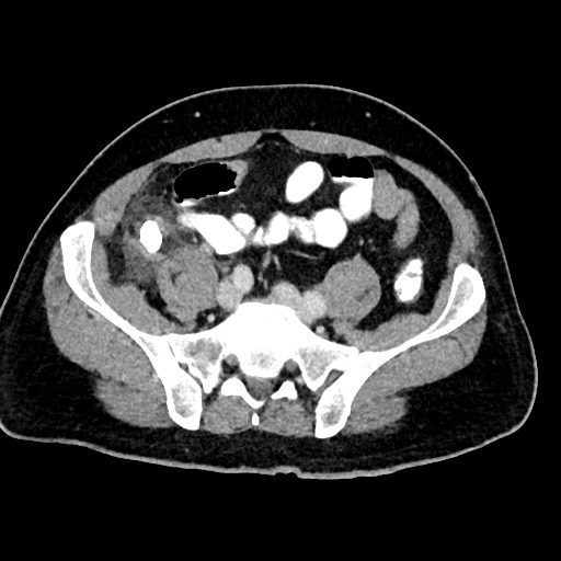 Acute appendicitis (Radiopaedia 77016-88960 Axial C+ portal venous phase 103).jpg