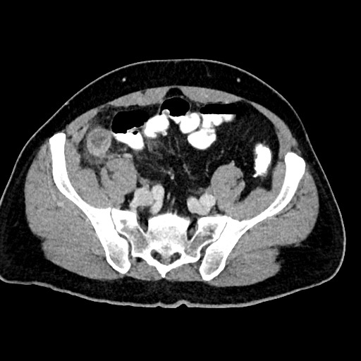 Acute appendicitis (Radiopaedia 77016-88960 Axial C+ portal venous phase 108).jpg