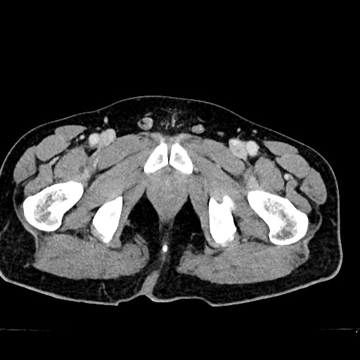 Acute appendicitis (Radiopaedia 77016-88960 Axial C+ portal venous phase 147).jpg