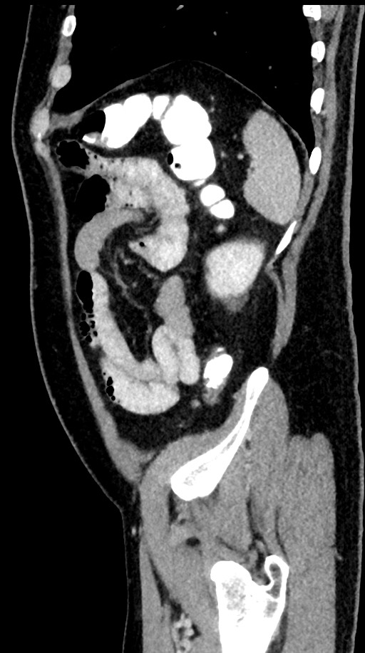 Acute appendicitis (Radiopaedia 77016-88960 Sagittal C+ portal venous phase 23).jpg