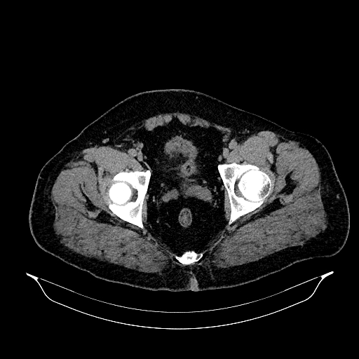 Acute appendicitis (Radiopaedia 79950-93224 Axial non-contrast 93).jpg
