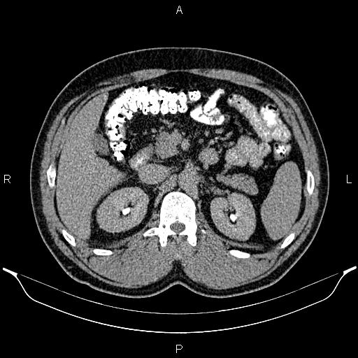 Acute appendicitis (Radiopaedia 84780-100240 Axial C+ delayed 35).jpg