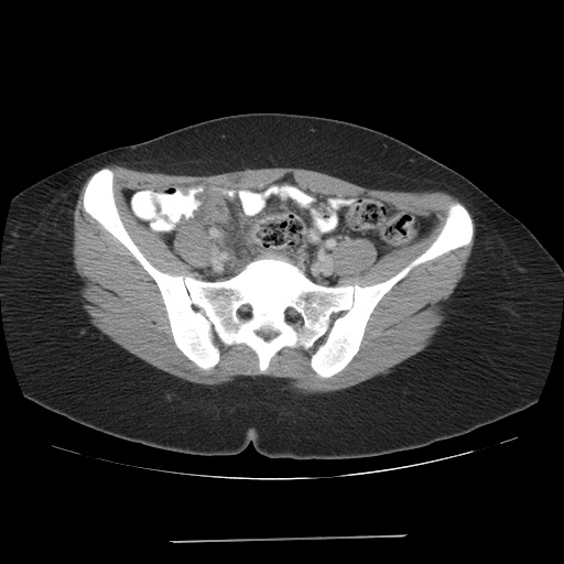 File:Acute appendicitis (Radiopaedia 9417-10099 Axial C+ portal venous phase 4).jpg