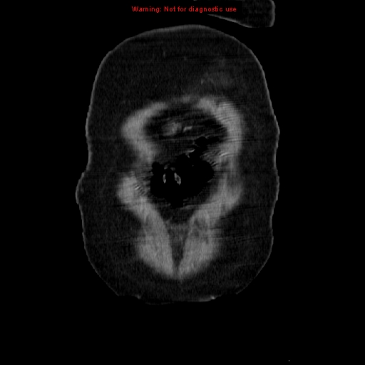 File:Acute appendicitis complicated by ovarian vein thrombophlebitis (Radiopaedia 16172-15851 Coronal C+ portal venous phase 10).jpg