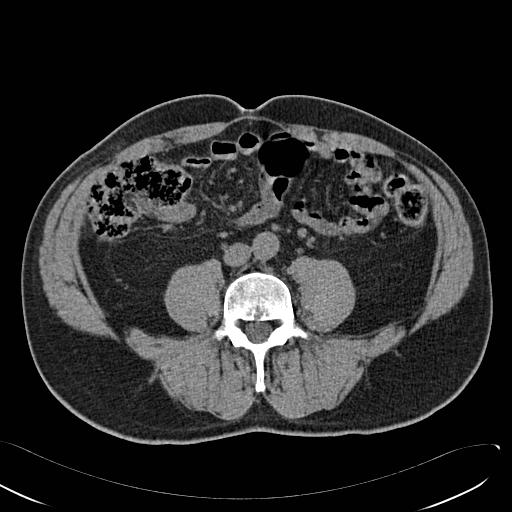 File:Acute appendicitis with appendicolith (Radiopaedia 6062).jpg