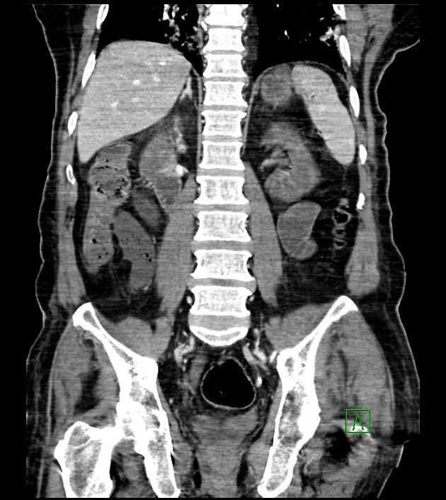 Acute arterial mesenteric ischemia (Radiopaedia 78238-90828 Coronal C+ portal venous phase 61).jpg