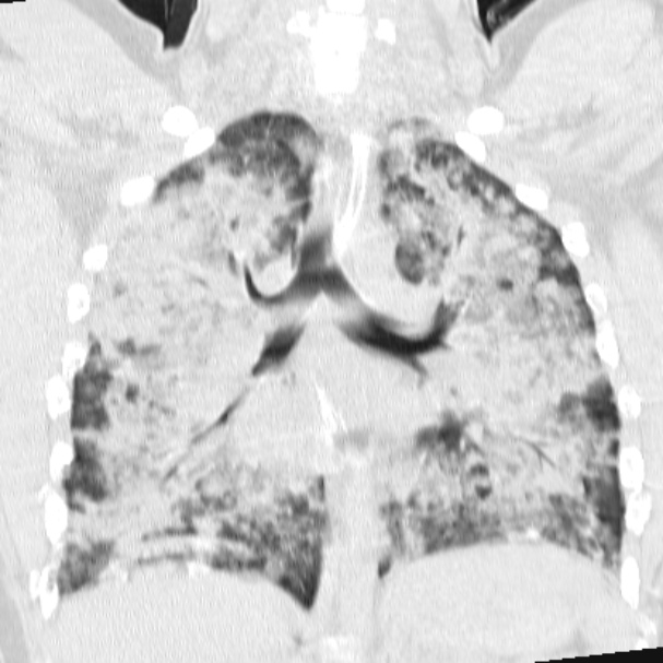 Acute aspiration pneumonitis (Radiopaedia 33605-34703 Coronal lung window 49).jpg