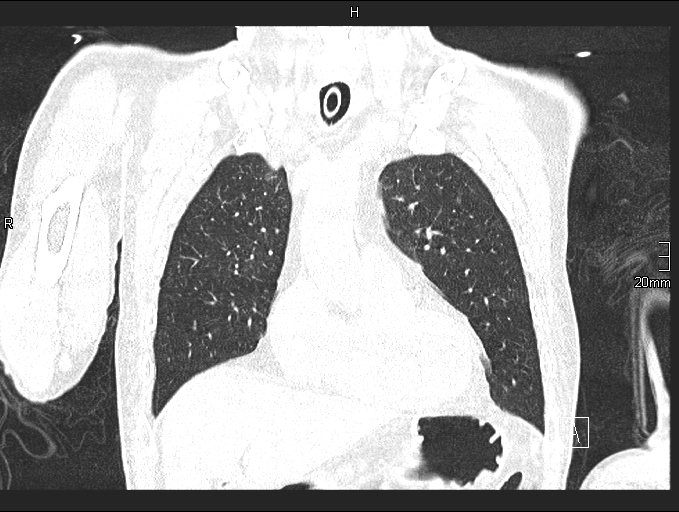 File:Acute aspiration pneumonitis (Radiopaedia 55642-62166 Coronal lung window 28).jpg