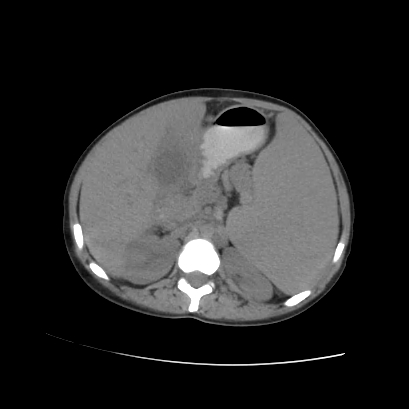 File:Acute calculous cholecystitis in patient with osteopetrosis (Radiopaedia 77871-90159 Axial non-contrast 36).jpg