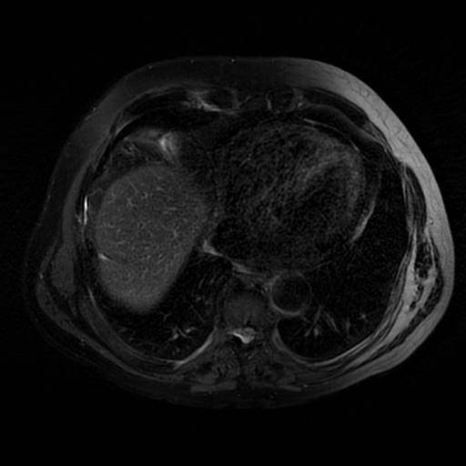 File:Acute cholecystitis complicated by pylephlebitis (Radiopaedia 65782-74915 Axial T2 fat sat 4).jpg