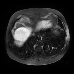 File:Acute cholecystitis complicated by pylephlebitis (Radiopaedia 65782-74915 Axial arterioportal phase T1 C+ fat sat 4).jpg