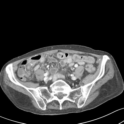 Acute cholecystitis with contained perforation (Radiopaedia 47328-51907 Axial C+ portal venous phase 51).png