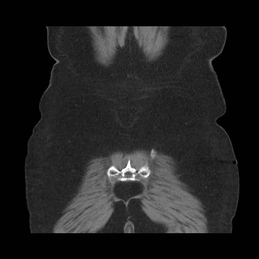 Acute cholecystitis with tensile fundus sign (Radiopaedia 71394-81723 Coronal non-contrast 109).jpg
