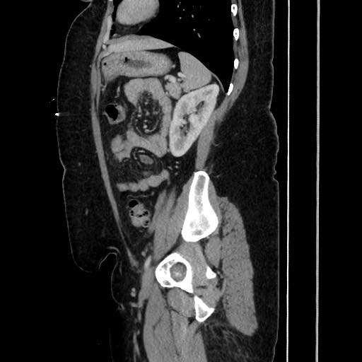 Acute diverticulitis - transverse colon (Radiopaedia 87063-103327 Sagittal C+ portal venous phase 157).jpg