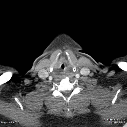 File:Acute epiglottitis (Radiopaedia 54375-60590 Axial C+ arterial phase 48).jpg