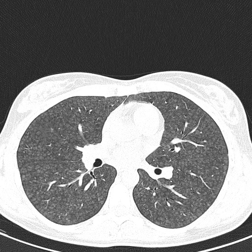 File:Acute hypersensitivity pneumonitis (Radiopaedia 85293-100870 Axial lung window 58).jpg