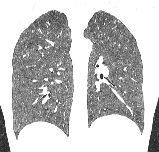 File:Acute hypersensitivity pneumonitis (Radiopaedia 85293-100870 Coronal lung window 88).jpg