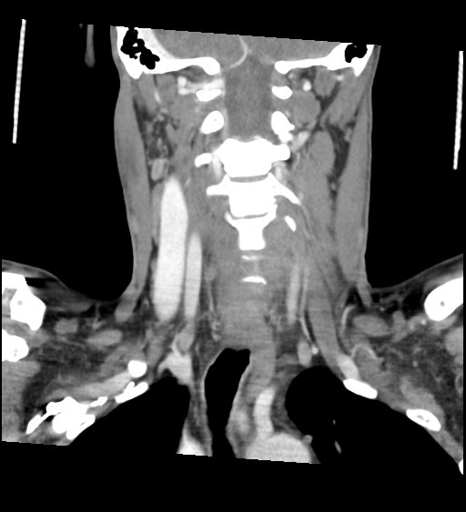 Acute longus colli calcific tendinitis (Radiopaedia 72495-83036 Coronal C+ arterial phase 39).jpg