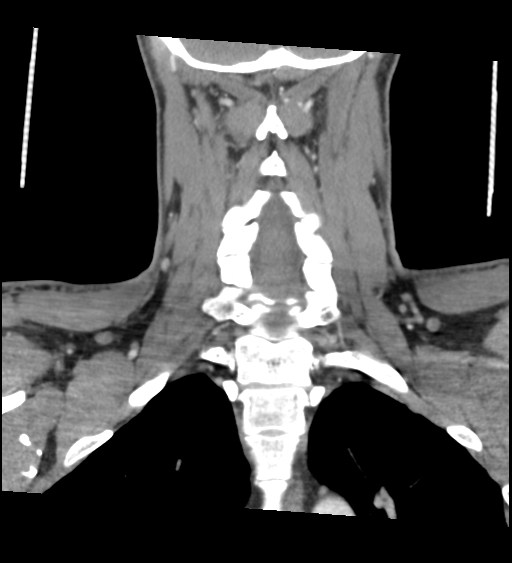 Acute longus colli calcific tendinitis (Radiopaedia 72495-83036 Coronal C+ arterial phase 49).jpg