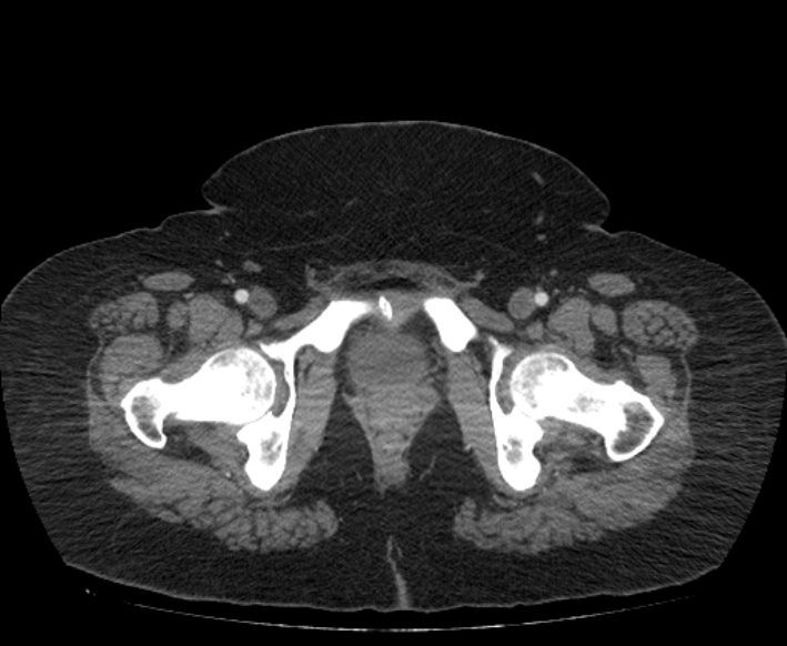 Acute mesenteric ischemia (Radiopaedia 80029-93316 Axial C+ arterial phase 134).jpg