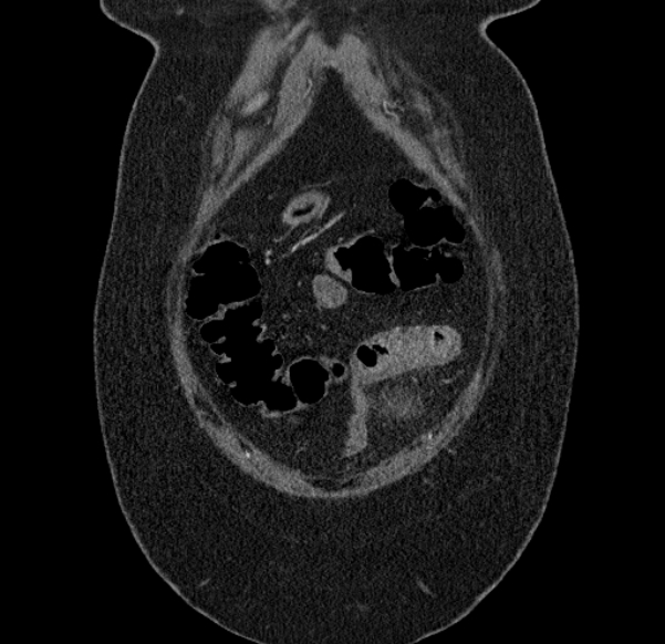 Acute mesenteric ischemia (Radiopaedia 80029-93316 Coronal C+ arterial phase 11).jpg