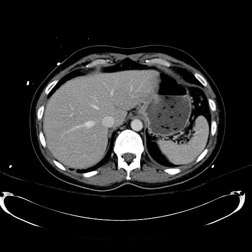 Acute myocardial infarction in CT (Radiopaedia 39947-42415 Axial C+ portal venous phase 25).jpg