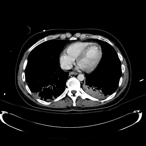 File:Acute myocardial infarction in CT (Radiopaedia 39947-42415 Axial C+ portal venous phase 7).jpg