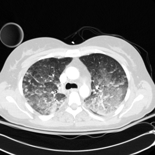 Acute myocardial infarction in CT (Radiopaedia 39947-42415 Axial lung window 41).jpg