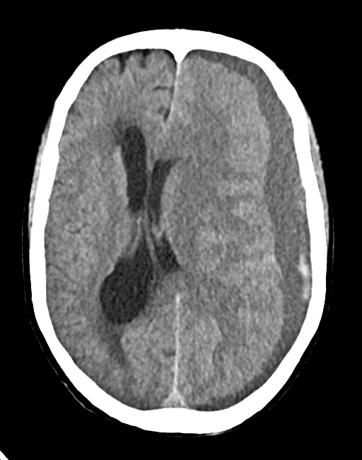 Acute on chronic subdural hematoma (Radiopaedia 74814-85823 Axial non-contrast 49).jpg