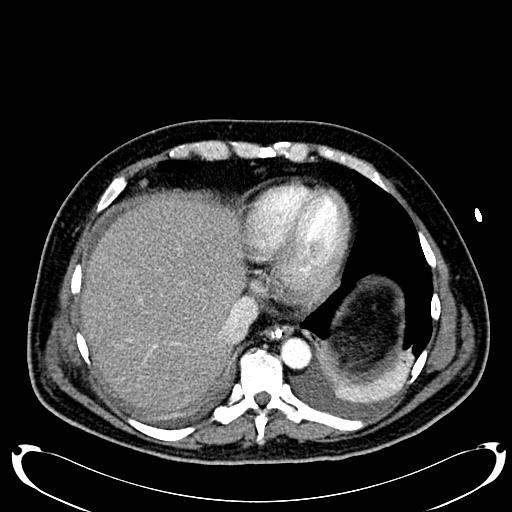 Acute pancreatic necrosis (Radiopaedia 13560-18500 Axial C+ portal venous phase 22).jpg