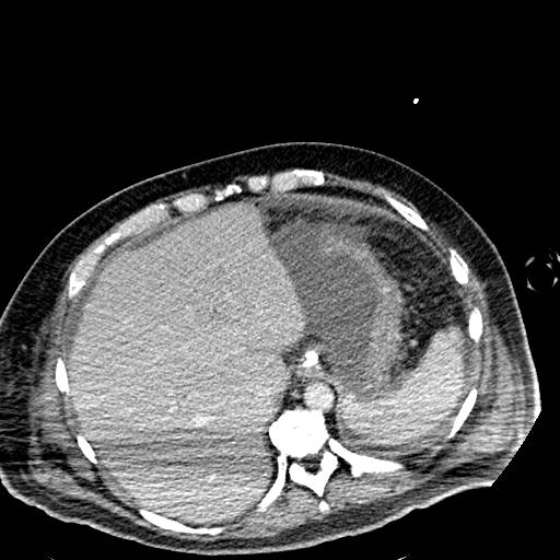 Acute pancreatic necrosis (Radiopaedia 13560-18501 Axial C+ portal venous phase 20).jpg