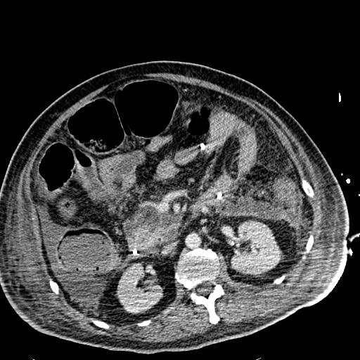 Acute pancreatic necrosis (Radiopaedia 13560-18501 Axial C+ portal venous phase 60).jpg