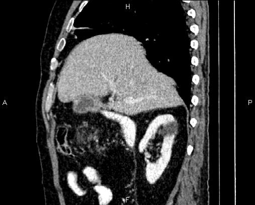Acute pancreatitis (Radiopaedia 85146-100701 Sagittal C+ portal venous phase 25).jpg