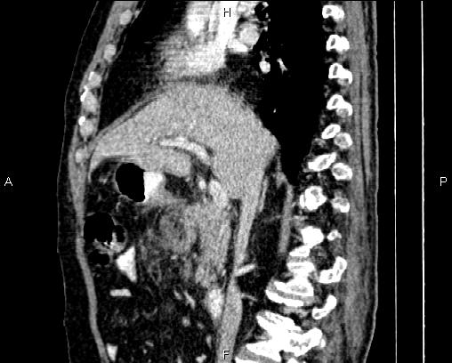 Acute pancreatitis (Radiopaedia 85146-100701 Sagittal C+ portal venous phase 38).jpg