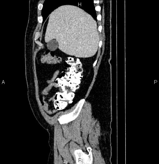 Acute pancreatitis (Radiopaedia 85390-101010 Sagittal C+ portal venous phase 13).jpg