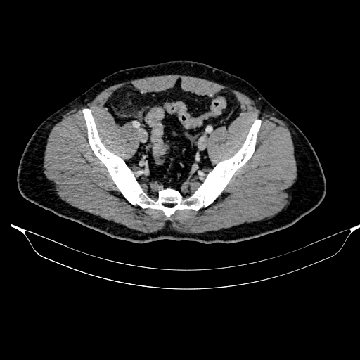 Acute pancreatitis (Radiopaedia 87428-103757 Axial C+ portal venous phase 81).jpg