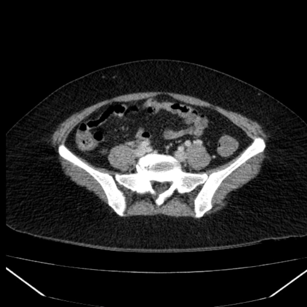 Acute pancreatitis - Balthazar C (Radiopaedia 26569-26714 Axial C+ portal venous phase 70).jpg