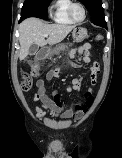 Acute pancreatitis - Balthazar E (Radiopaedia 23080-23110 Coronal C+ portal venous phase 22).jpg
