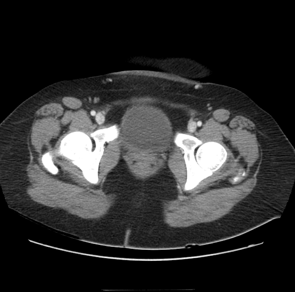 Acute pancreatitis - Balthazar E (Radiopaedia 29016-29377 Axial C+ portal venous phase 72).png