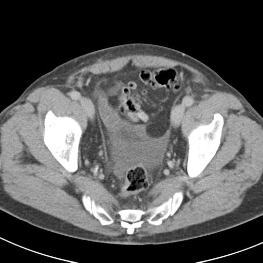 Acute pancreatitis and walled-off necrosis (Radiopaedia 29888-30403 Axial C+ delayed 73).jpg