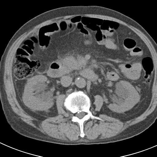 File:Acute pancreatitis and walled-off necrosis (Radiopaedia 29888-30403 Axial non-contrast 32).jpg