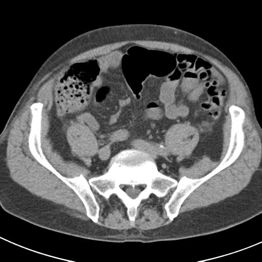 File:Acute pancreatitis and walled-off necrosis (Radiopaedia 29888-30403 Axial non-contrast 55).jpg