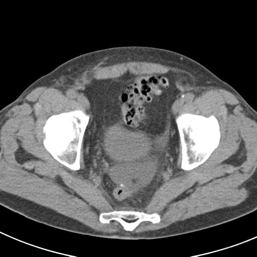 File:Acute pancreatitis and walled-off necrosis (Radiopaedia 29888-30403 Axial non-contrast 69).jpg