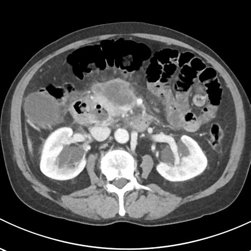 File:Acute pancreatitis and walled-off necrosis (Radiopaedia 29888-30404 Axial C+ portal venous phase 35).jpg